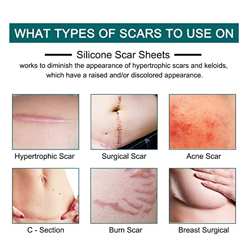Silicone Scar Sheets Roll V9253